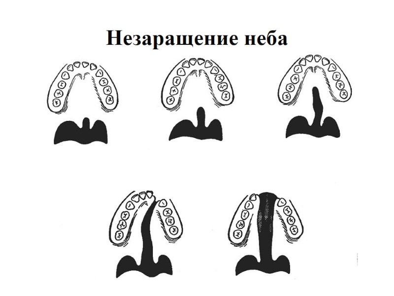 Незаращение неба